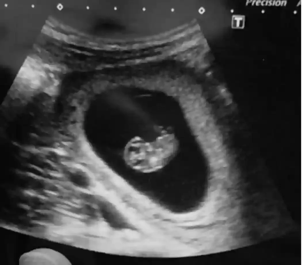 Early Pregnancy Ultrasound