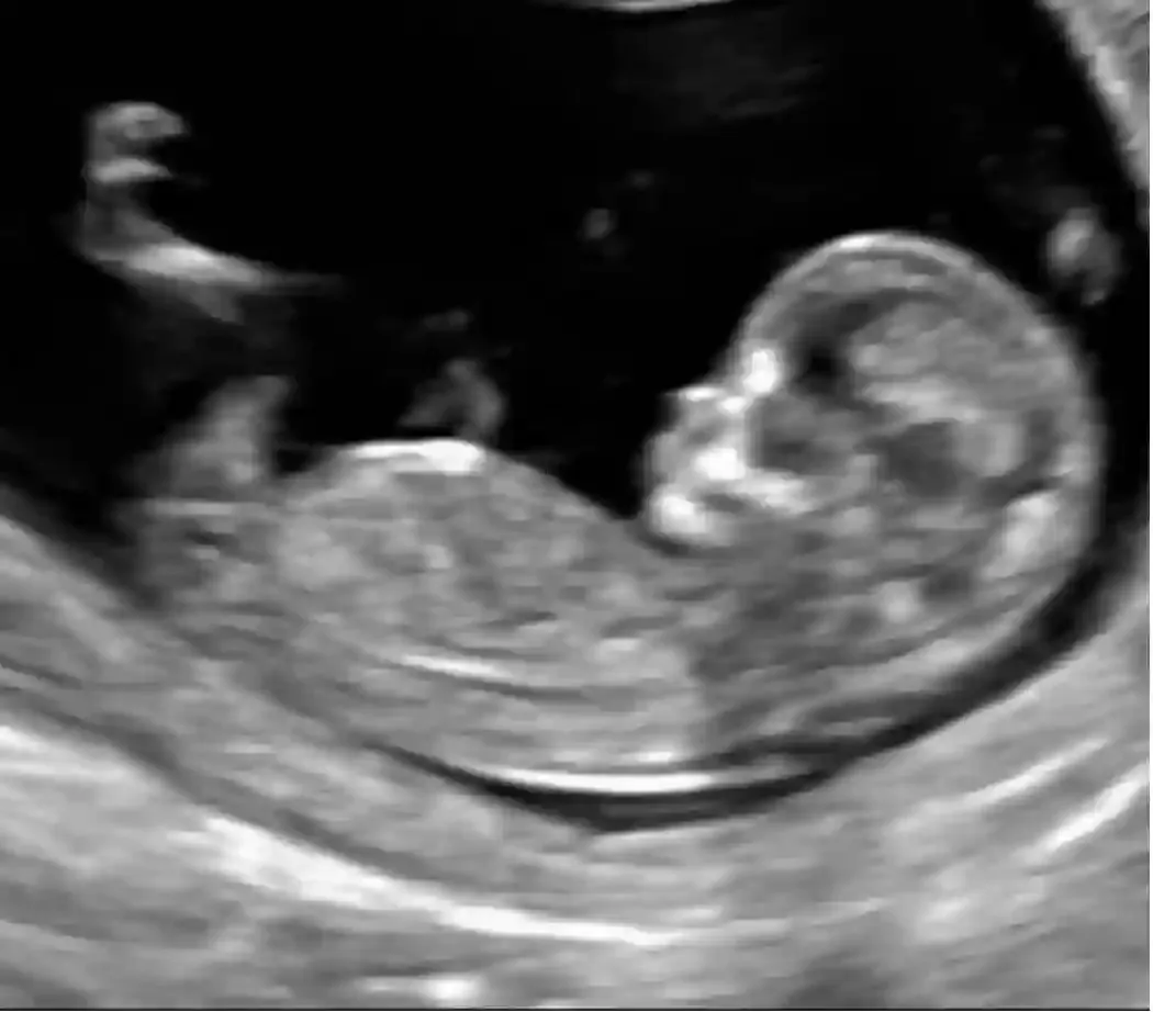 Gender Determination Ultrasound